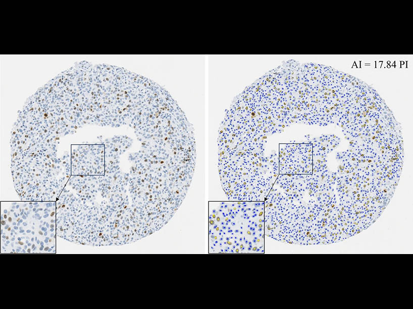 Two photos of zoomed in tissue microarrays, one less clear than the other, showing how the AI tool offers more accuracy 