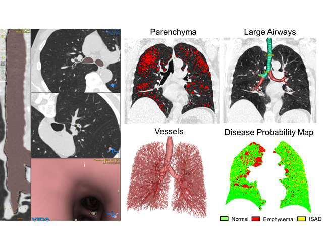 Left Panel.  VIDA Diagnostics Inc. software (Coralville, IA, USA) enables segmentation of lung structures, such as the airways of the lung shown here in pink, and three dimensional (3D) reconstructions of the airway tree. Right Panel.  Quantitative analysis of the lungs includes parenchymal measurements of emphysematous tissue destruction (highlighted in red), airway measurements that are derived from the 3D airway tree (pathway to a particular airway segment ie. RB1 is highlighted in green), vessel measurements, as well as disease probability map measurements that classify voxels in the lung as normal, emphysema and functional small airway disease (fSAD).