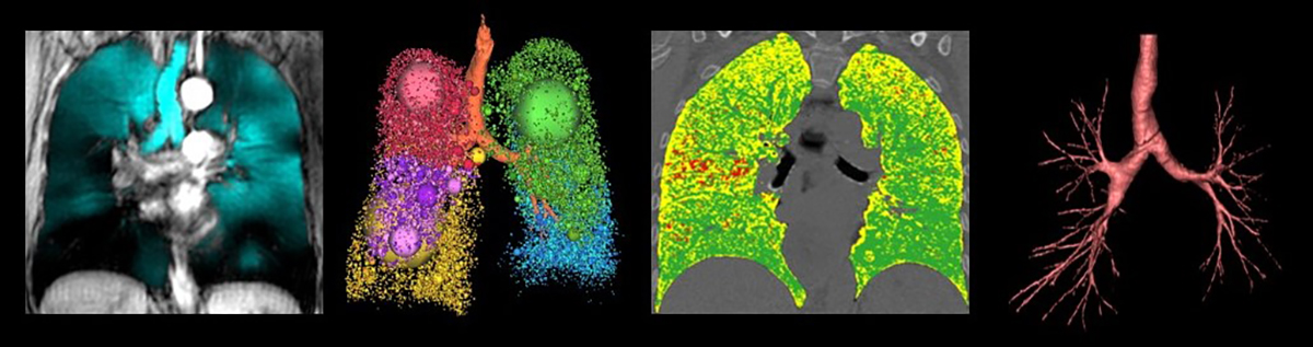 Four images of lungs side by side with a black background.